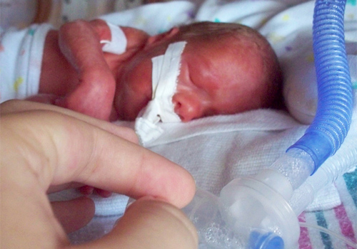 Premature baby girl 26 weeks, 6 days: Wikipedia/ceejayoz