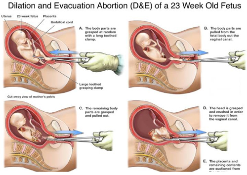 Dismemberment abortion Lifenews.com