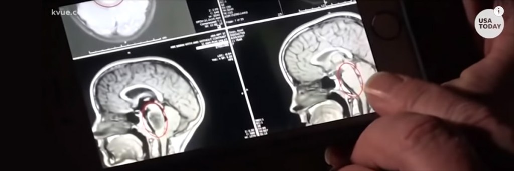 Texas doctors stunned as rare, deadly, incurable brain tumor miraculously&nbsp;disappears