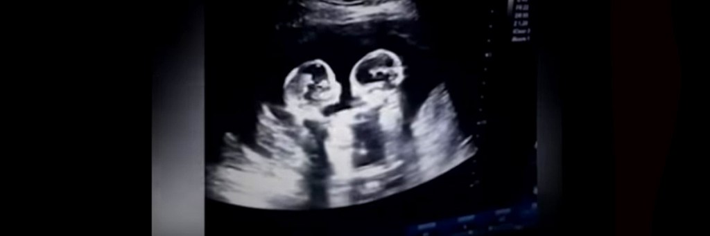 Ultrasound of dangerous Mo-Mo pregnancy reveals two sisters fighting in the&nbsp;womb