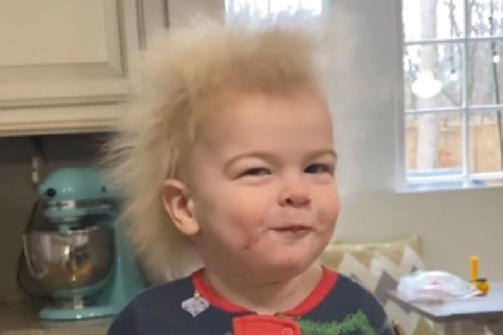 ‘Uncontrollable Hair Syndrome’ is&nbsp;real